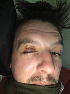 Injured eyelid was one of the everest basecamp accidents
